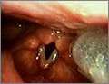 Endoscope Video